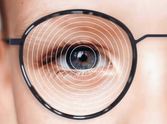 Budowa soczewki ZEISS MyoCare z pierścieniami technologii C.A.R.E.